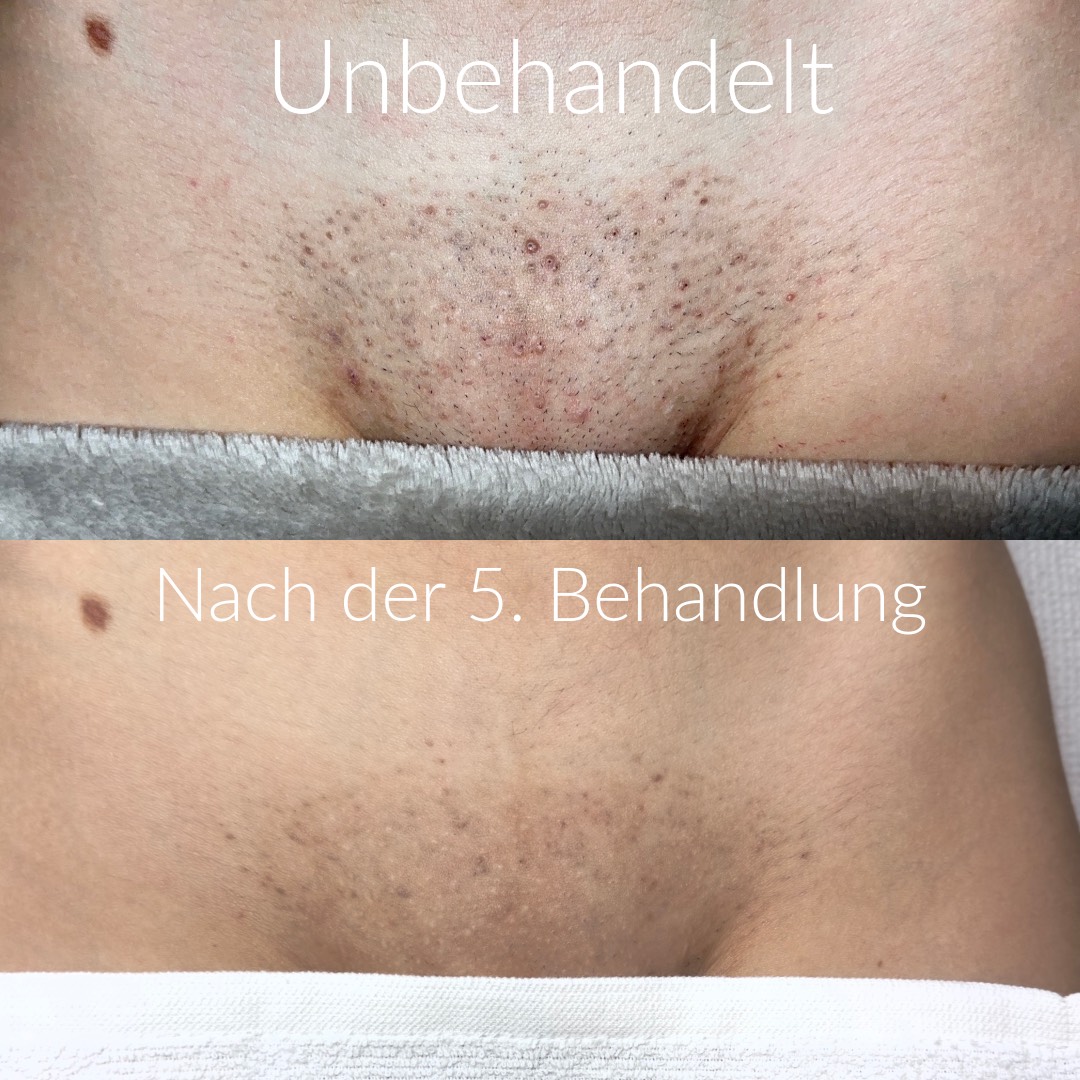 Vorher/Nachher Schambereich Behandlung 2